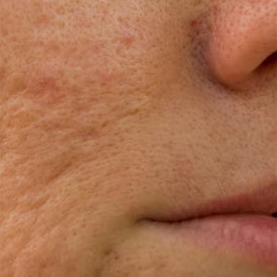 acne