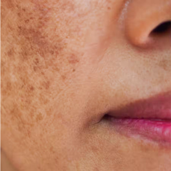 pigmentation